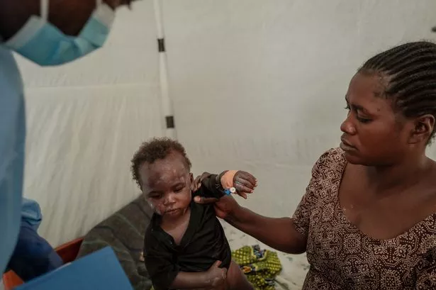 Mpox:专家如此担心女性感染病毒的可怕原因
